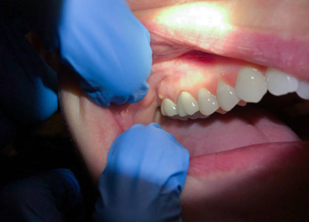 Best Emergency Tooth Extraction in Barbourville, KY